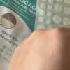 Salicylic Acid Acne Patch – Fast-Acting Blemish Treatment - Image 5
